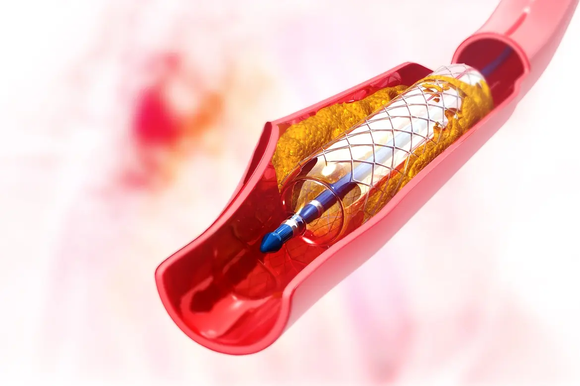 Hiệu quả của stent trong điều trị bệnh mạch vành được bao lâu?